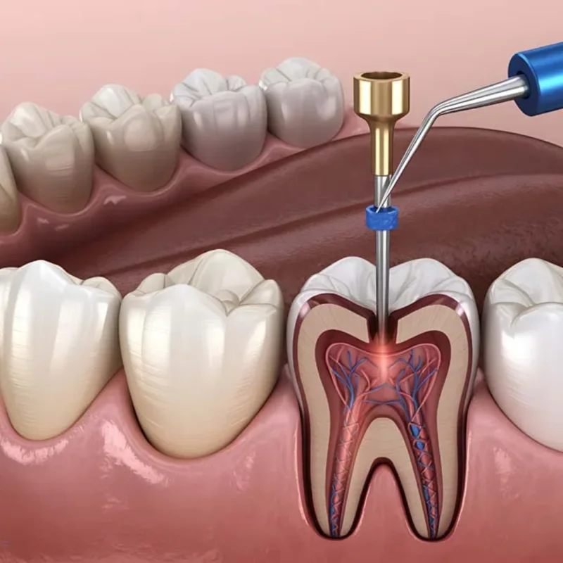 Root Canal Treatment